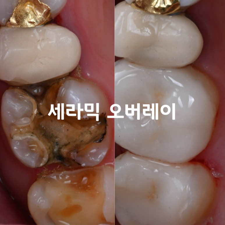 [치료사례] 어금니 충치치료, 크라운 말고 다른 방법은 없을까요? 세라믹 오버레이 치료.