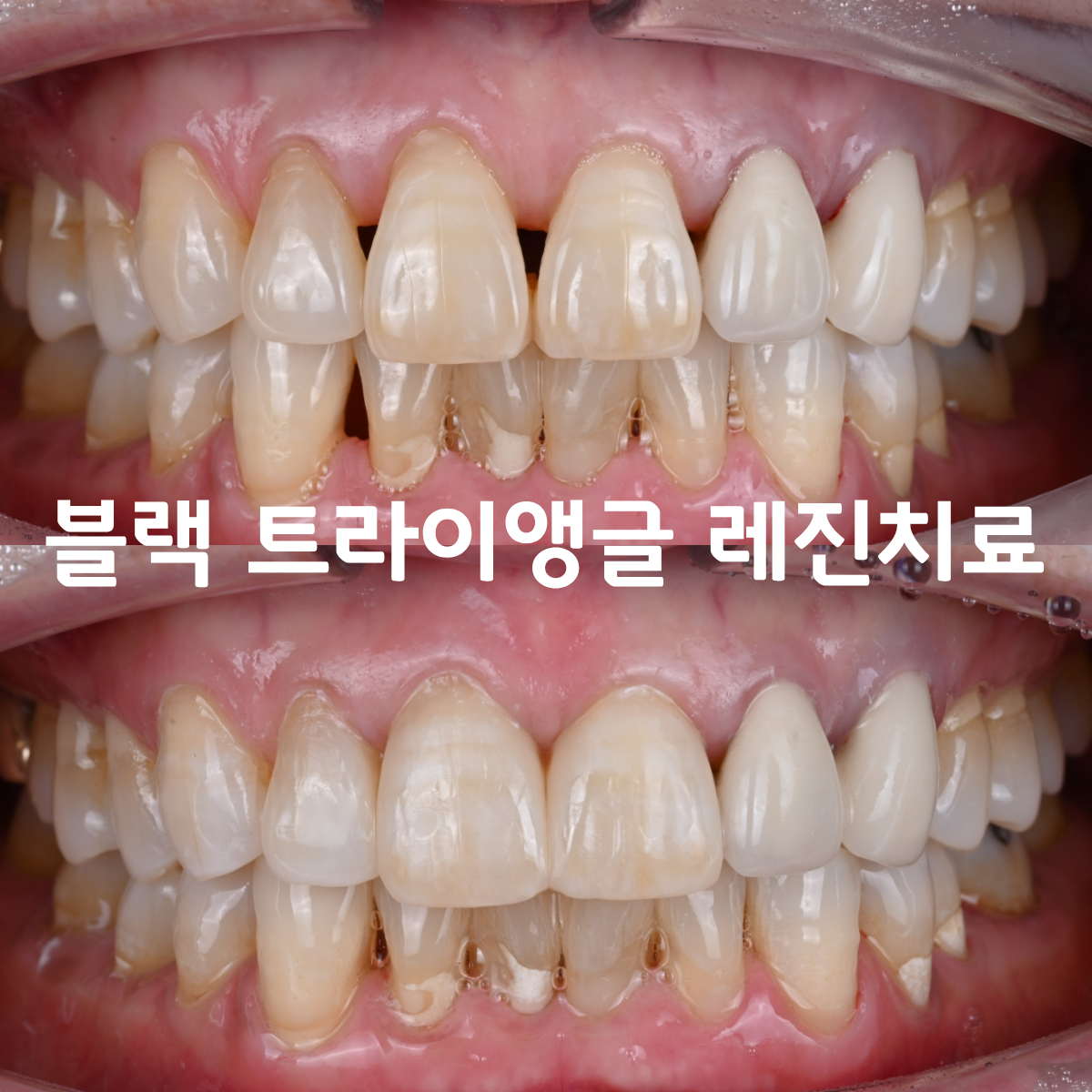 [치료사례] 앞니 사이 검은 삼각형(블랙 트라이앵글), 크라운 없이 당일 레진으로 해결할 수 있을까요?