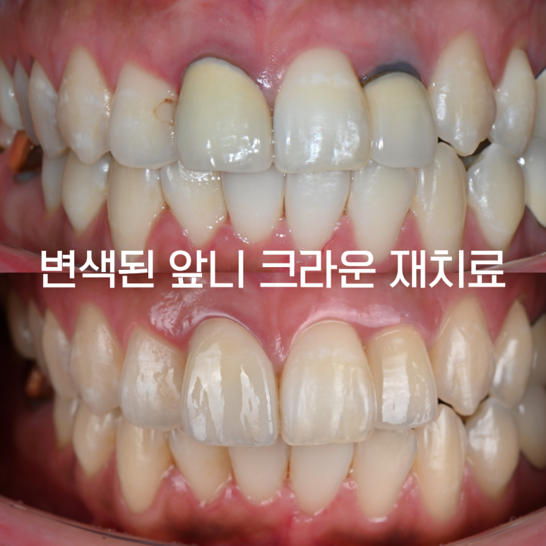 [치료사례] 