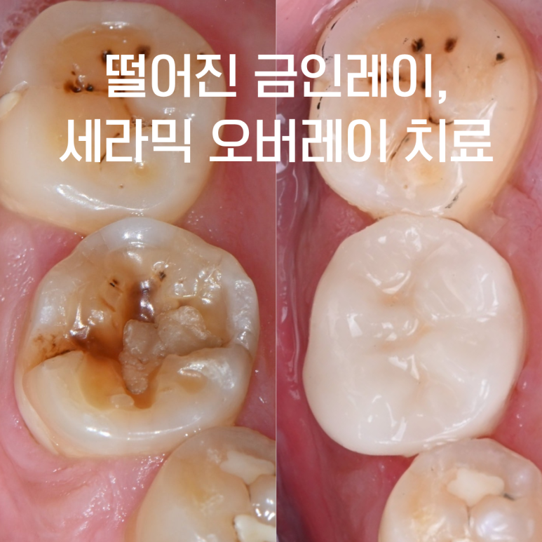 어금니 금 인레이가 빠졌을 때 치료 방법: 미세금(크랙) 발견 후 세라믹 오버레이 사례 | 삼산동치과, 부천 이보다치과