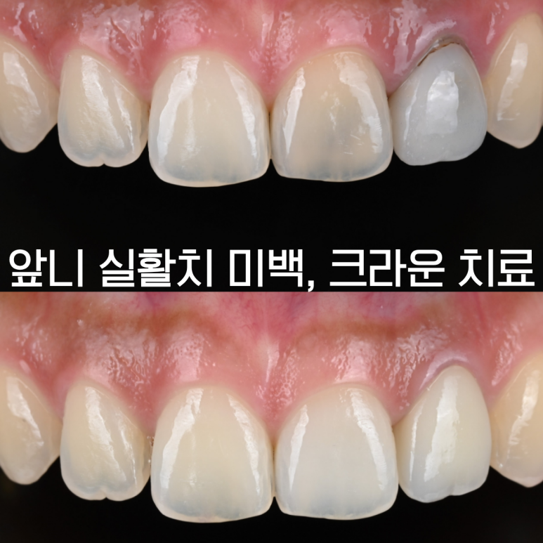 [치료사례] 예전에 치료 받은 치아가 어둡게 변하고 염증이 생겼어요. 크라운 없이 실활치 미백으로 해결한 케이스. 부천치과.