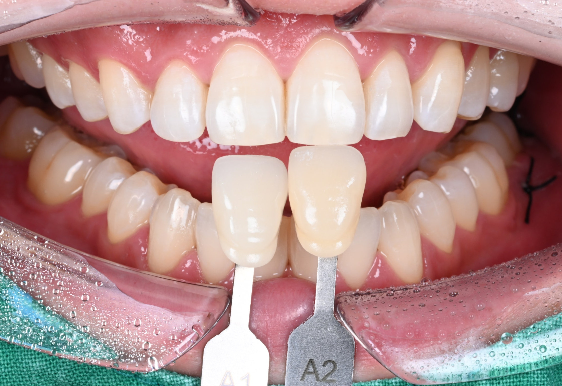 치아미백이 이루어지는 과정, 소요시간 정리!