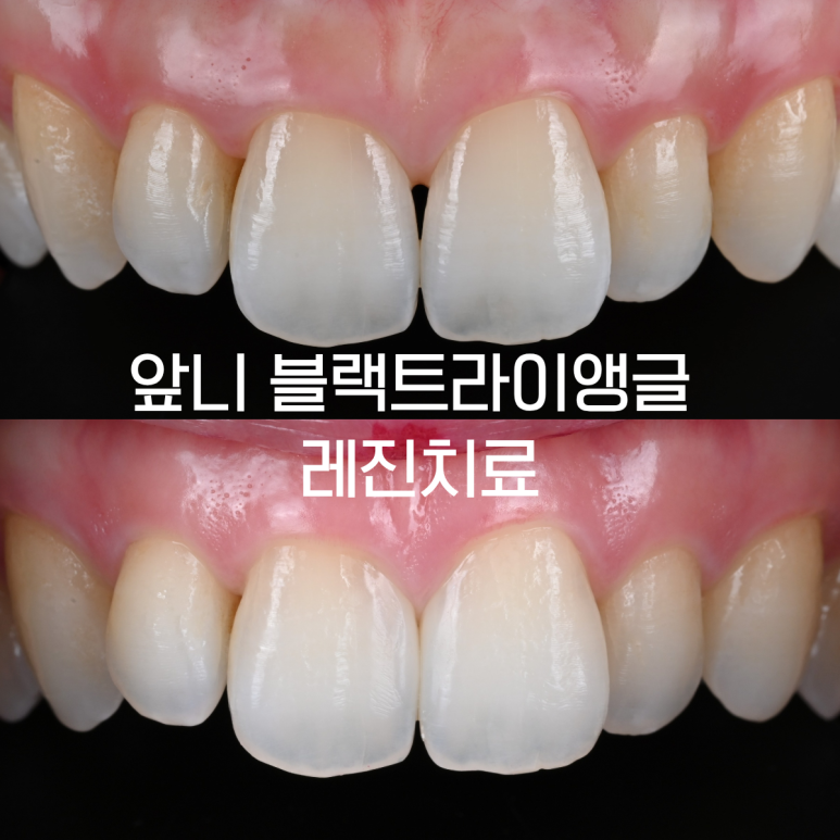 앞니 블랙트라이앵글 레진 치료 후 잇몸이 다시 차오를 수 있을까? 앞니 사이공간이 생기는 이유와  5mm 법칙의 과학적 원리