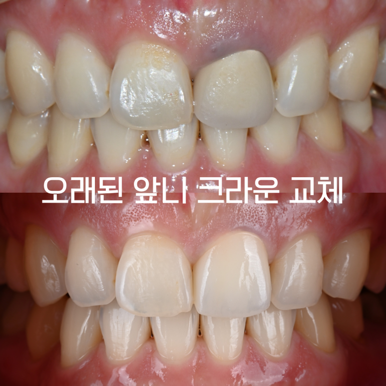 앞니 크라운 주변 잇몸이 검게 변하는 이유와 교체 치료 과정 | 부천 이보다치과