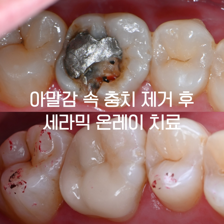 [치료사례] 충치가 깊어 신경치료 권유를 받았다면? 자연치아를 살리는 보존적 세라믹 온레이 치료법
