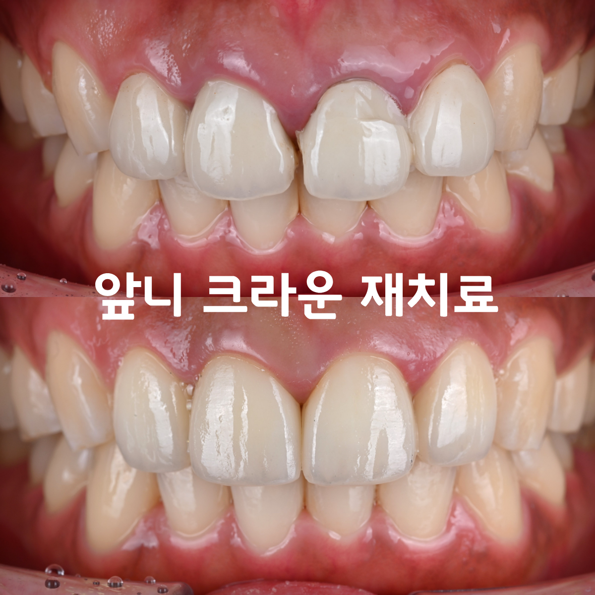 [치료사례] 오래된 앞니 크라운이 깨졌는데 어떻게 해야하나요...?