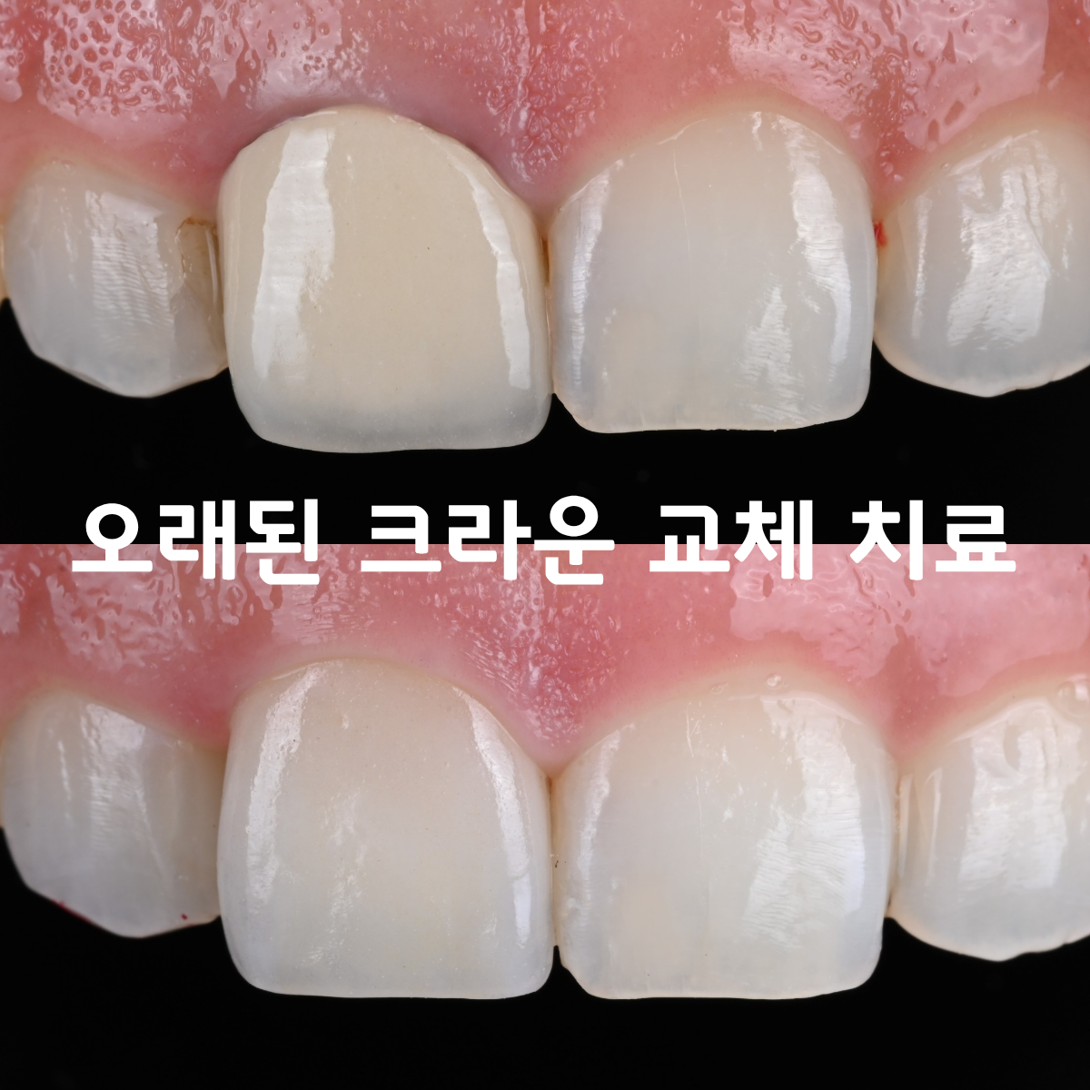 [치료사례] 오래된 앞니 크라운, 색이 안 맞고 잇몸이 까맣게 보인다면? PFZ크라운으로 해결한 케이스. 앞니 크라운 재치료.