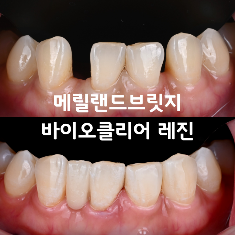 [치료사례] 부천치과 아래 앞니 사이 공간이 너무 커요... 바이오클리어 레진과 메릴랜드 브릿지로 해결한 케이스.
