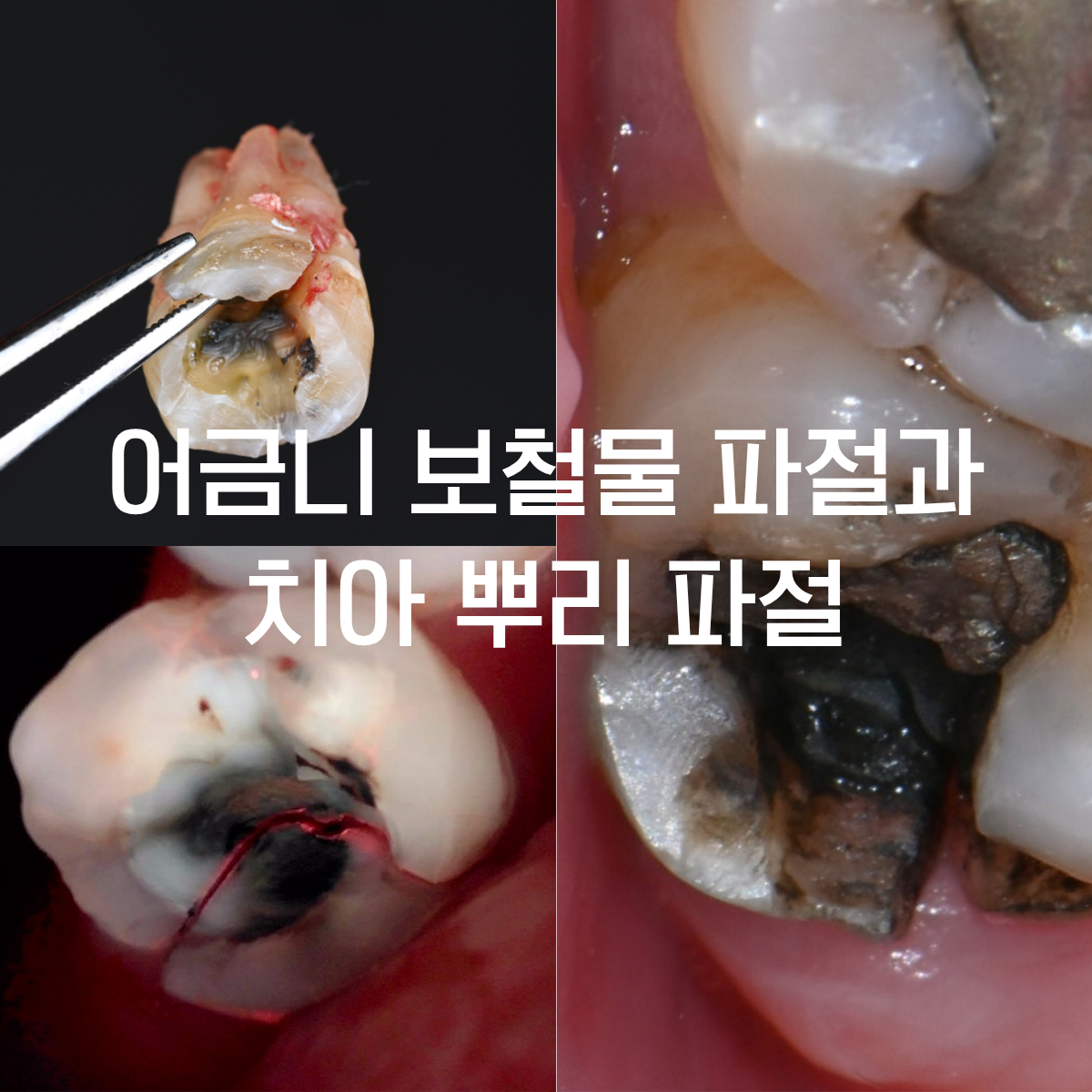 어금니 보철물 탈락 후 수직 치근 파절(VRF): 큐레이·CT 정밀 진단과 치료 한계