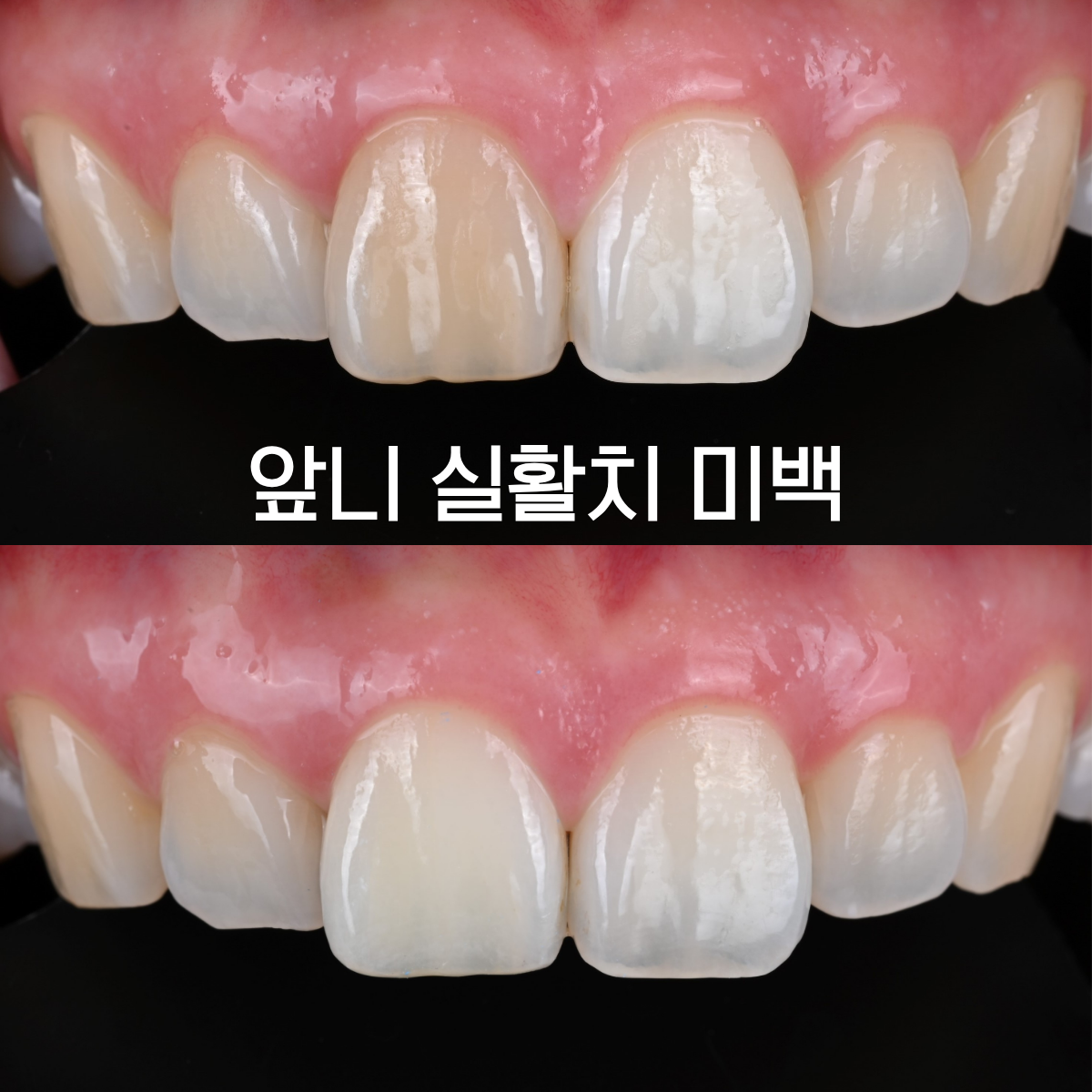 [치료사례] 앞니 하나가 색깔이 어둡게 변했다면? 크라운 없이 실활치 미백만으로 해결한 케이스와 실활치 미백이란?