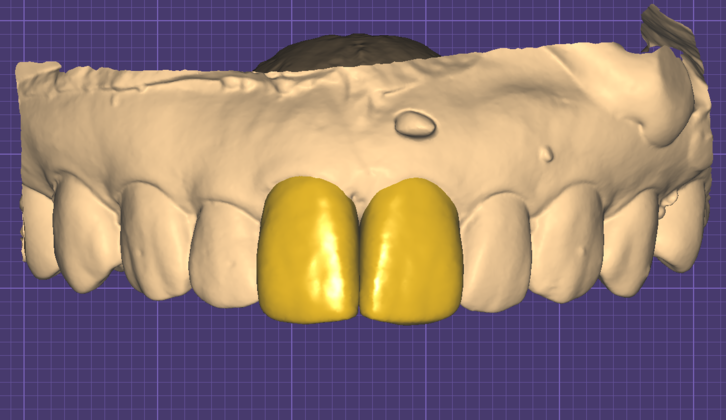 최종 보철물 3D 디자인