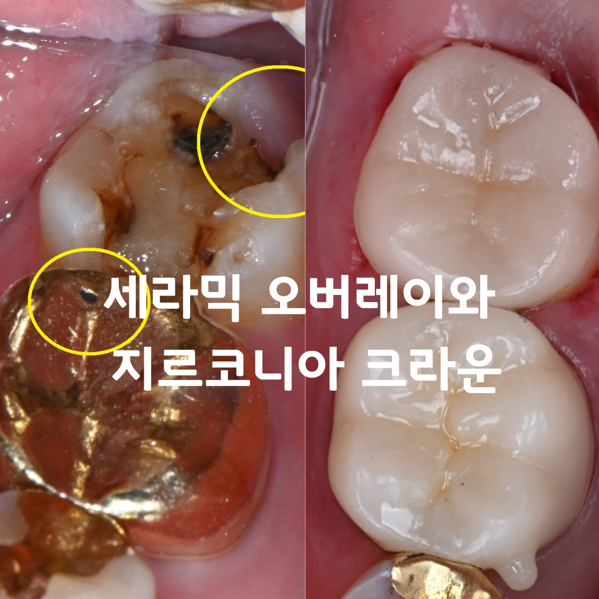 [치료사례] 치실하다 금니가 빠졌어요 — 세라믹 오버레이와 지르코니아 크라운으로 두 어금니를 한 번에 해결한 케이스